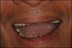 Before Patient missing all upper teeth wearing a denture.