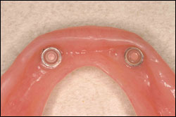 Step 3 Retentive inserts inside the denture to hook to the “trailer hitches.”     